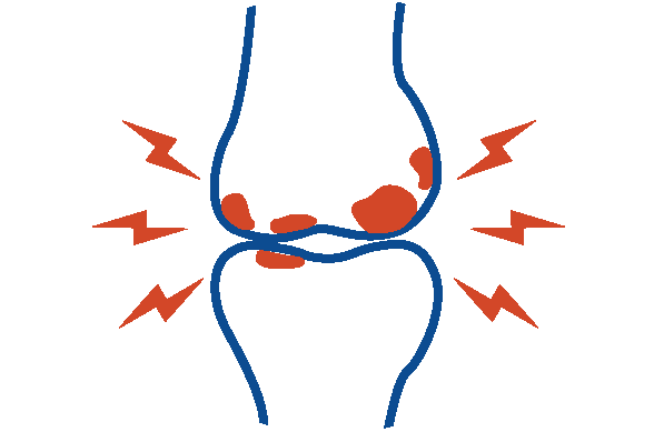 Osteoarthritis